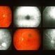 Blastomycosis Blastomycosis